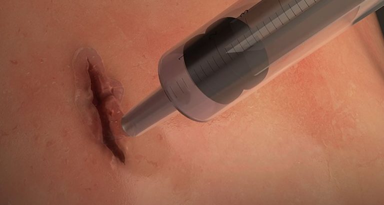 Znanstvenici razvili elastično kirurško ljepilo koje djeluje za 60 sekundi